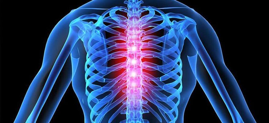Akuter Schmerz ist charakteristisch für eine Verschlimmerung der Osteochondrose der Brustwirbelsäule