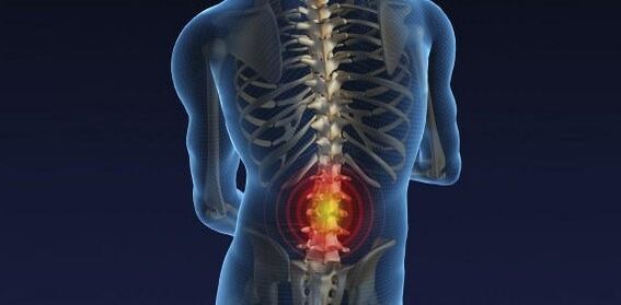 Rückenschmerzen mit Osteochondrose der Lendenwirbelsäule