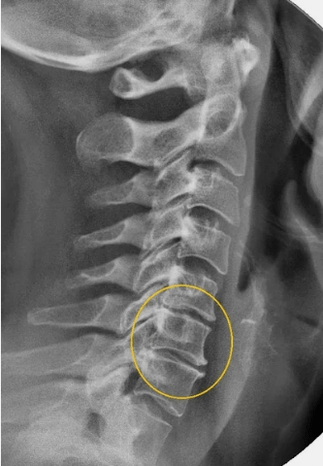Osteochondrose der Halswirbelsäule auf einem X -Strahlen