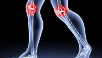 Vorbeugung der Entwicklung von Arthritis und Arthrose