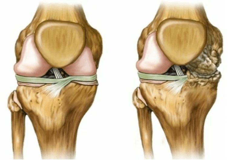 Arthrosestadien