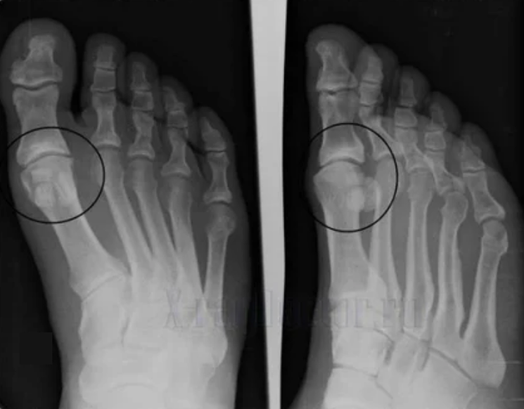 Diagnose von Arthrose