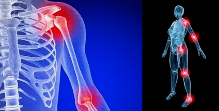 Gliedmaßenverformung für Arthrose