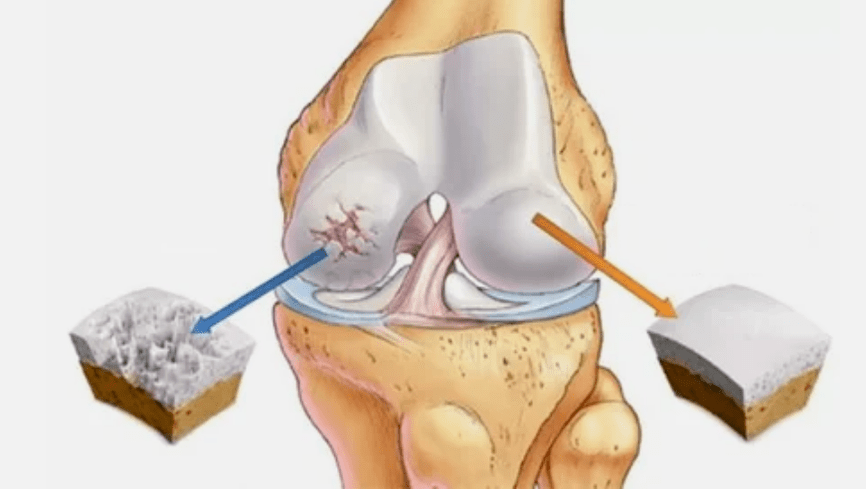 Wie sich Arthrose entwickelt
