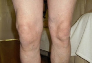 Manifestationen einer Arthrose des Kniegelenks (1)