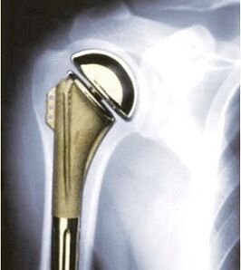 Schulterersatz bei Arthrose