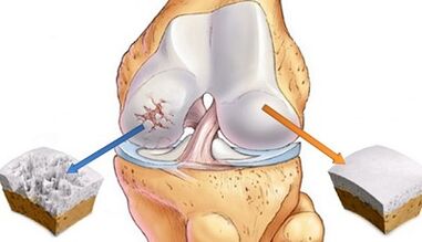 Ursachen der Arthrose der Gelenke