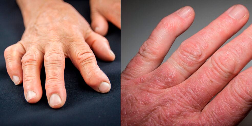 rheumatoide und psoriatische Arthritis der Hände