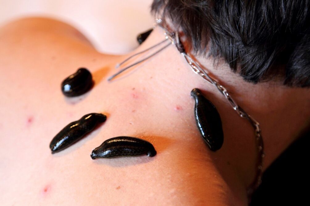 Blutegel gegen zervikale Osteochondrose