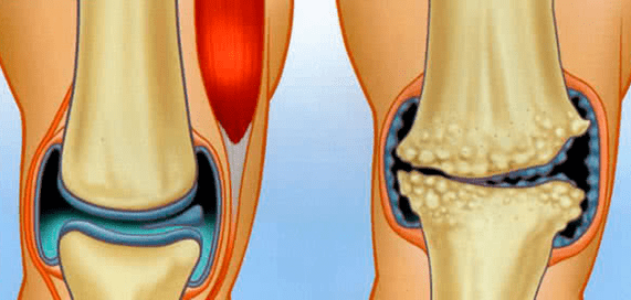 Normales Gelenk und Arthrose